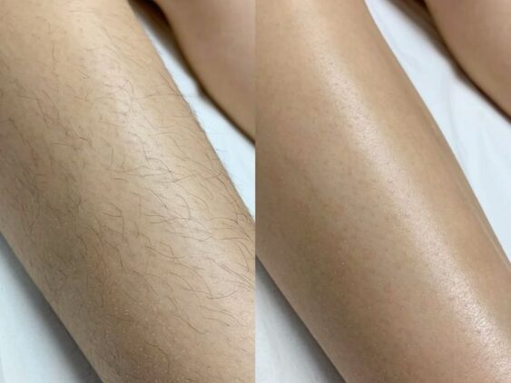 Before-After-Legs-Laser-Hair-removal-Lahore