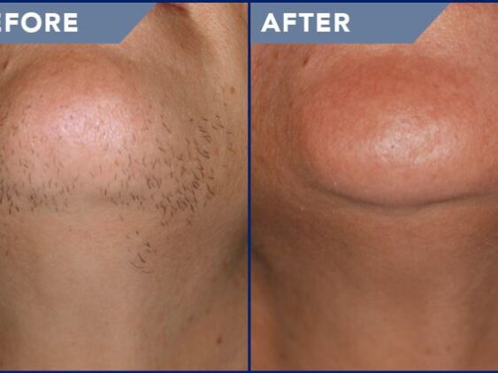 Before-after-laser-hair-removal-face