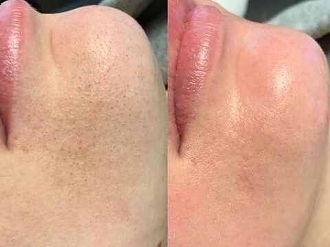 Face-Laser-Hair-removal-Lahore