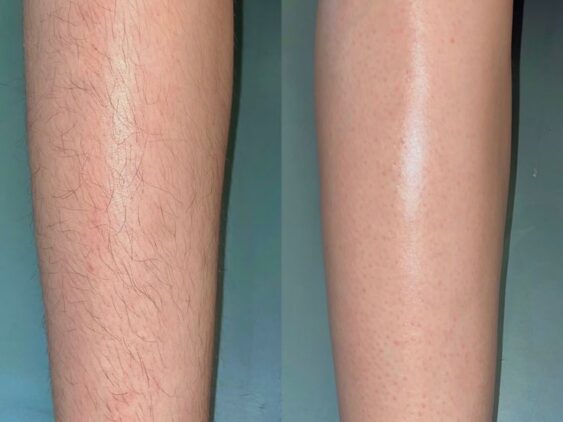 Johar-town-Laser-hair-removal