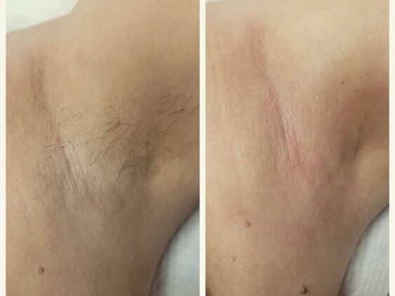 Under-Arm-laser-hair-removal-treatment