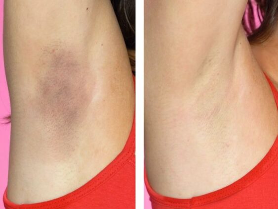 Under-arm-before-and-after-laser-hair-removal-in Lahore